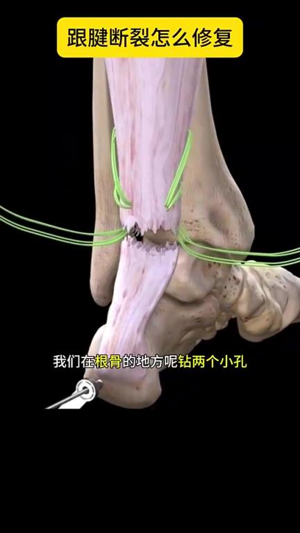 看着都疼啊科普帖：球员脚跟腱断裂是如何进行修复的？
